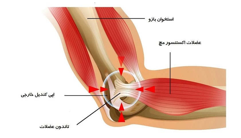 Tennis Elbow و CTS: چالش‌های شایع زنان خانه‌دار و درمان با کاردرمانی دست در مرکز صبا