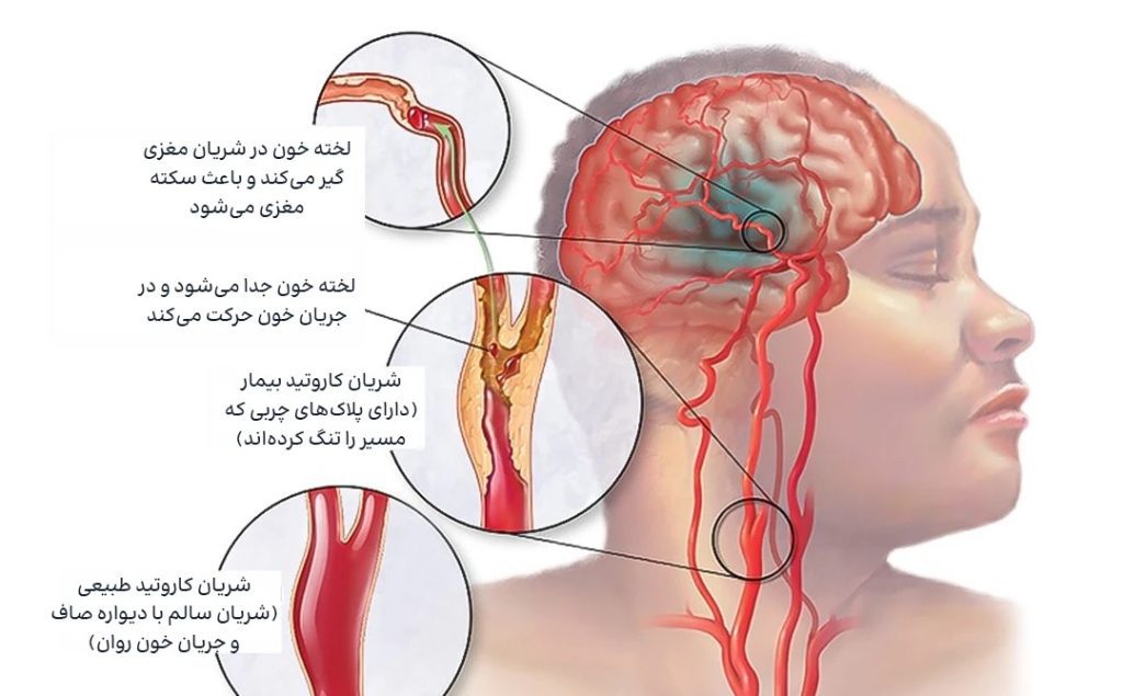 پاتوفیزیولوژی ایسکمیک در سکته مغزی حاد: نقش نوروپلاستیسیتی در بازیابی عملکردی