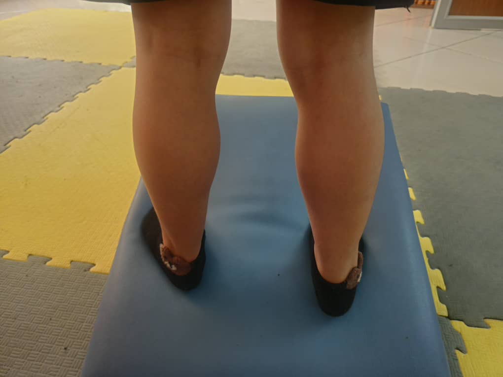 بیماری دوشن یک اختلال ژنتیکی جدی و پیش‌رونده است که با ضعف عضلانی، هایپرتروفی کاذب ساق و علامت گاورز همراه است. تشخیص زودهنگام و شروع درمان‌های حمایتی می‌تواند روند پیشرفت بیماری را کندتر کرده و کیفیت زندگی بیمار را بهبود بخشد.