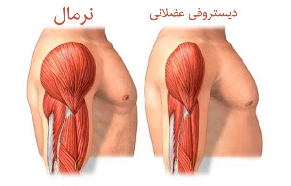 راهنمای جامع و تخصصی مرکز توانبخشی میوپاتی و دوشن (DMD) در تهران: استراتژی‌های مدیریت بیماری و حفظ حداکثری استقلال