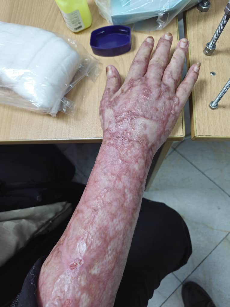 هند تراپی تخصصی برای آسیب‌های سوختگی و تصادف دست در کلینیک کاردرمانی و گفتار درمانی صبا