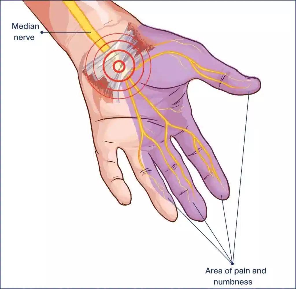 Tennis Elbow و CTS: چالش‌های شایع زنان خانه‌دار و درمان با کاردرمانی دست در مرکز صبا