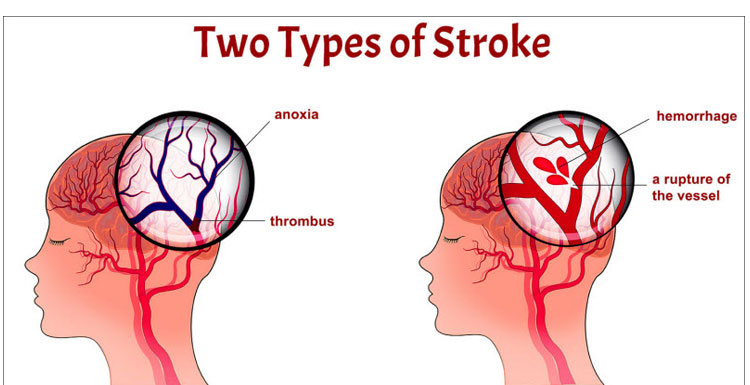 بهبود گفتار (آفازی)، بلع (دیسفاژی) و ارتباط پس از سکته مغزی | گفتاردرمانی تخصصی در مرکز کاردرمانی صبا شرق تهران