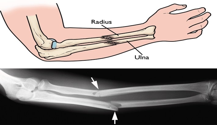 هندتراپی تخصصی و کاردرمانی دست پس از شکستگی، تاندونیت و سندرم تونل کارپال | کلینیک پیشرفته صبا در شرق تهران