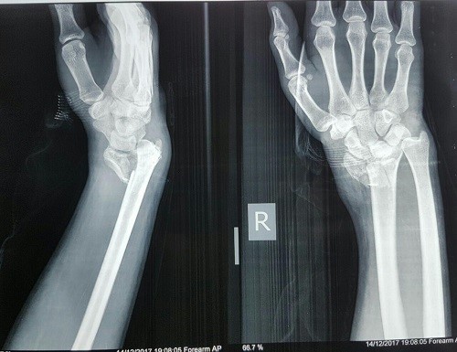 هندتراپی تخصصی و کاردرمانی دست پس از شکستگی، تاندونیت و سندرم تونل کارپال | کلینیک پیشرفته صبا در شرق تهران