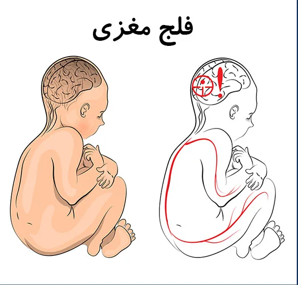 درمان اختلالات حرکتی، تعادلی و وضعیتی ناشی از فلج مغزی | برنامهریزی فردی در مرکز کاردرمانی صبا تهران